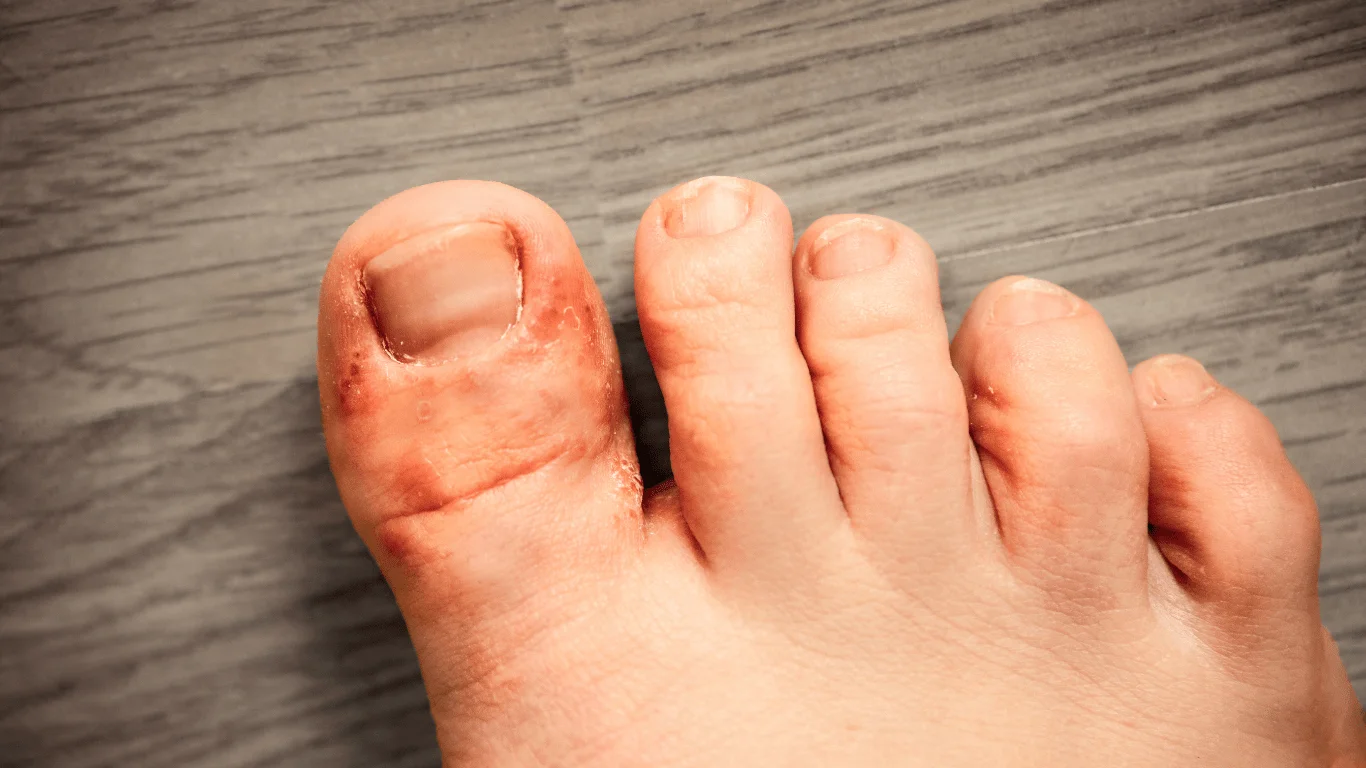 Fungal Infections Treatment Descriptions | QuickCare 365 Virtual Care