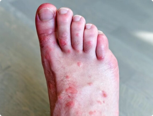 fungal infection treatment on telehealth